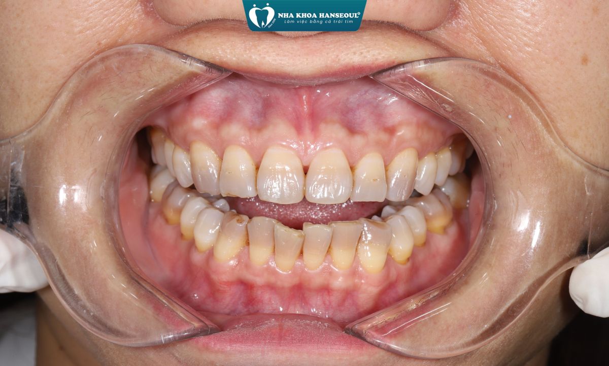 Bọc răng sứ bị mẻ